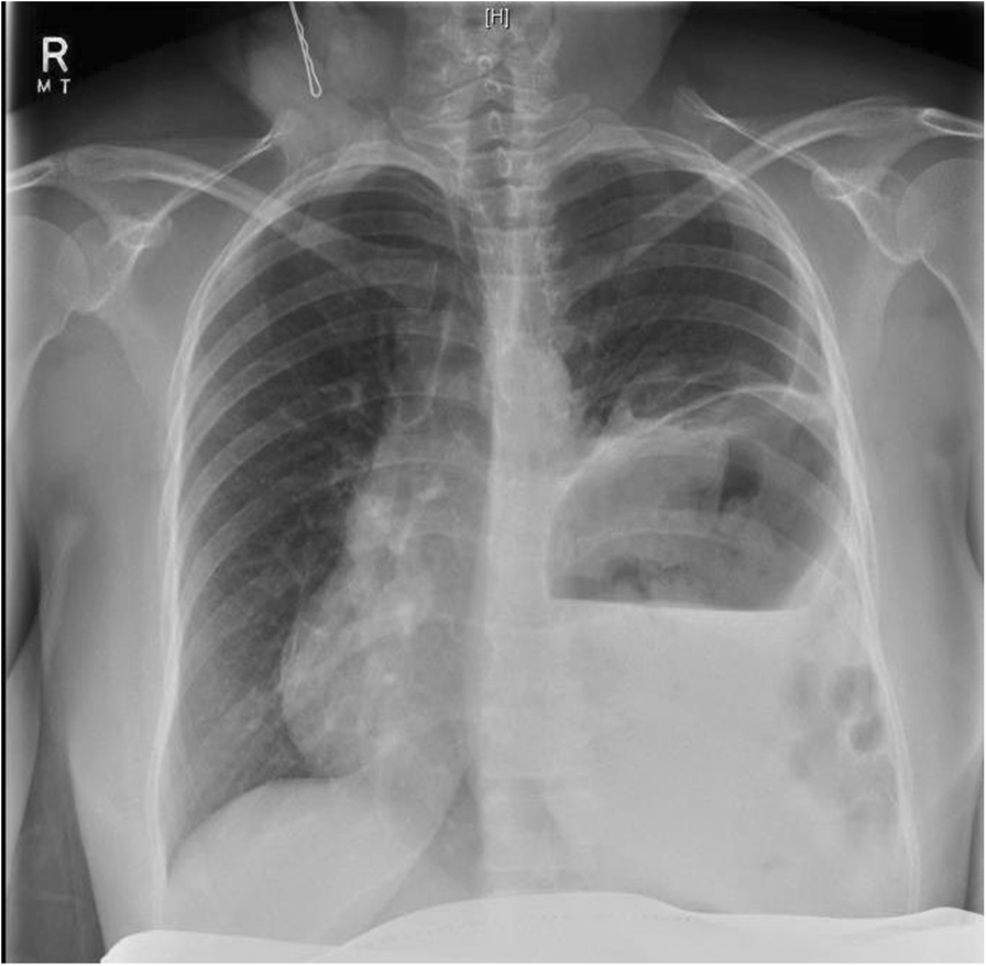 Undiagnosed maternal diaphragmatic hernia – a management dilemma | BMC  Pregnancy and Childbirth, image size:896x878