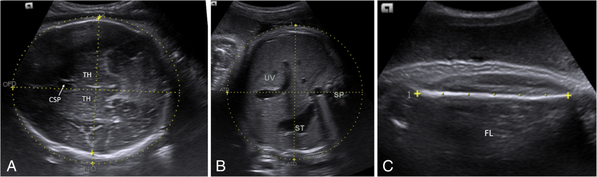 Prospective verification of sonographic fetal weight estimators ...