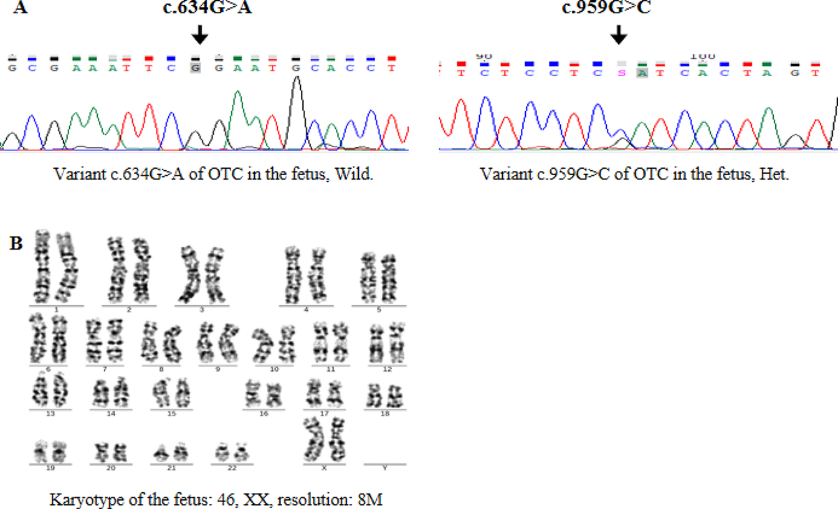 Variant analysis and PGT-M of OTC gene in a Chinese family with ornithine  carbamoyltransferase deficiency | BMC Pregnancy and Childbirth | Springer  Nature Link
