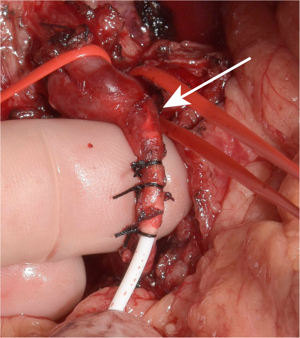 Adjuvant hepatic arterial infusion pump chemotherapy and resection versus  resection alone in patients with low-risk resectable colorectal liver  metastases – the multicenter randomized controlled PUMP trial | BMC Cancer  | Springer Nature Link