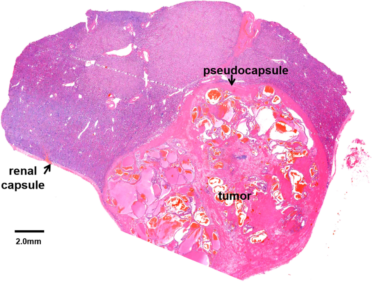 Pseudocapsule thickness is positively associated with prognosis in patients  with clear cell renal cell carcinoma | BMC Cancer, image size:1200x911