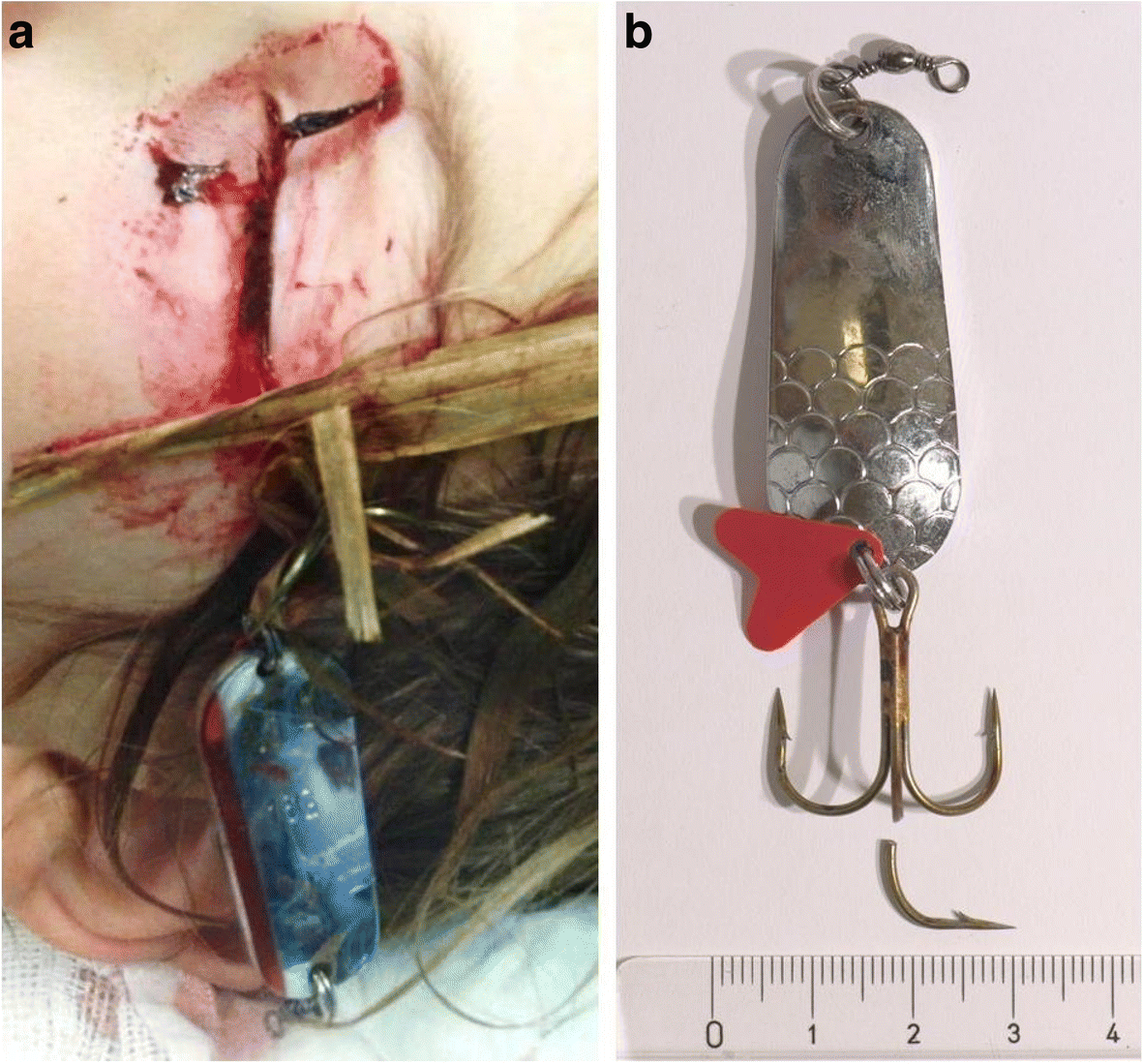 Open globe and penetrating eyelid injuries from fish hooks