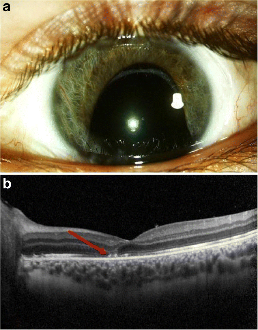 Open globe and penetrating eyelid injuries from fish hooks, BMC  Ophthalmology