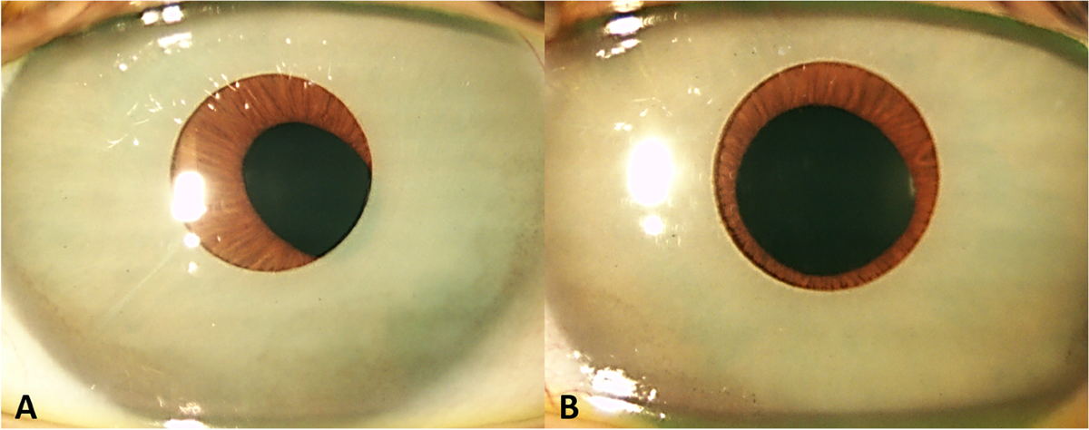 Long-term complications of iris implants