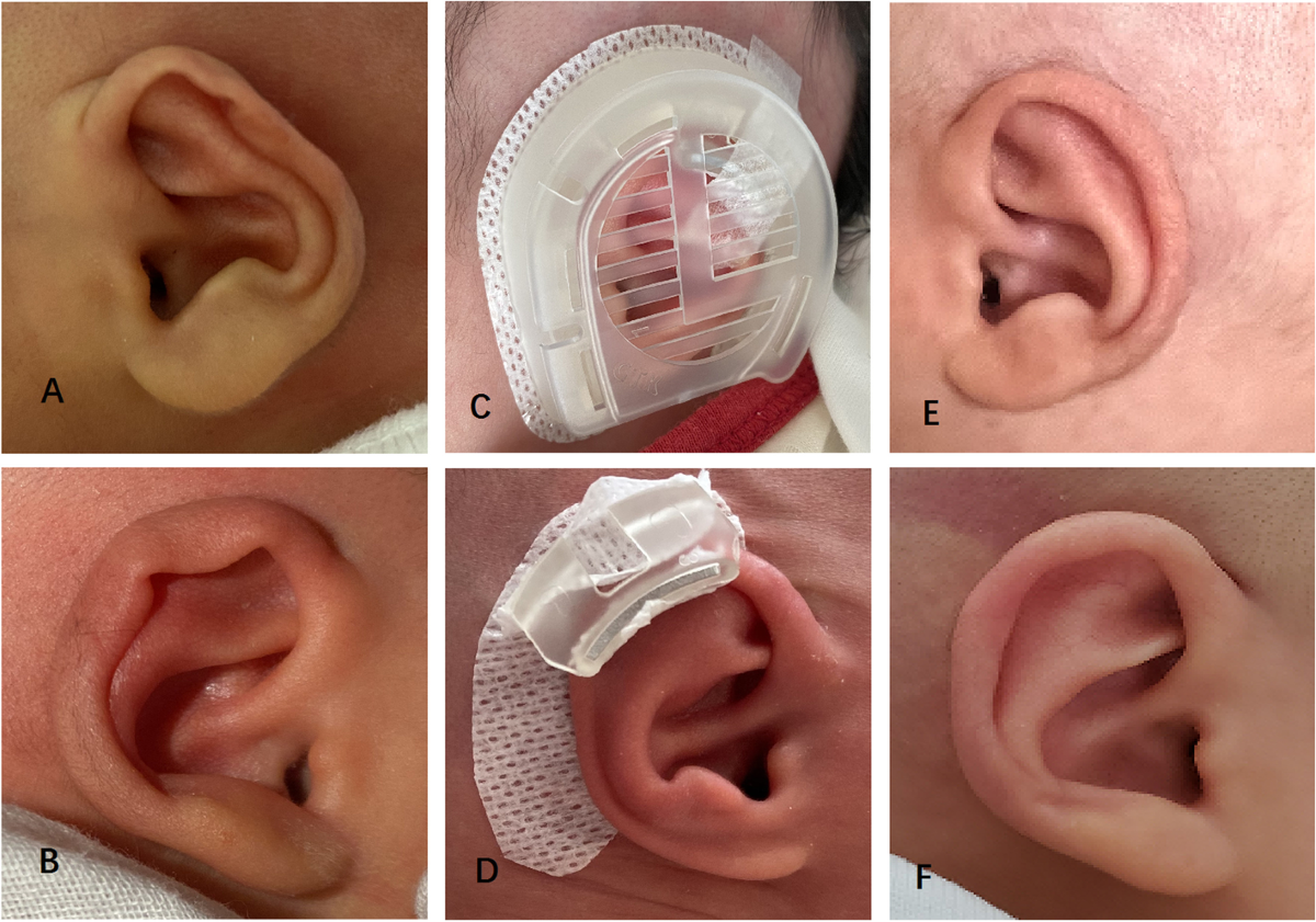 The advantages of domestic ear molding system in molding bilateral neonatal  congenital auricular deformities | BMC Pediatrics | Springer Nature Link