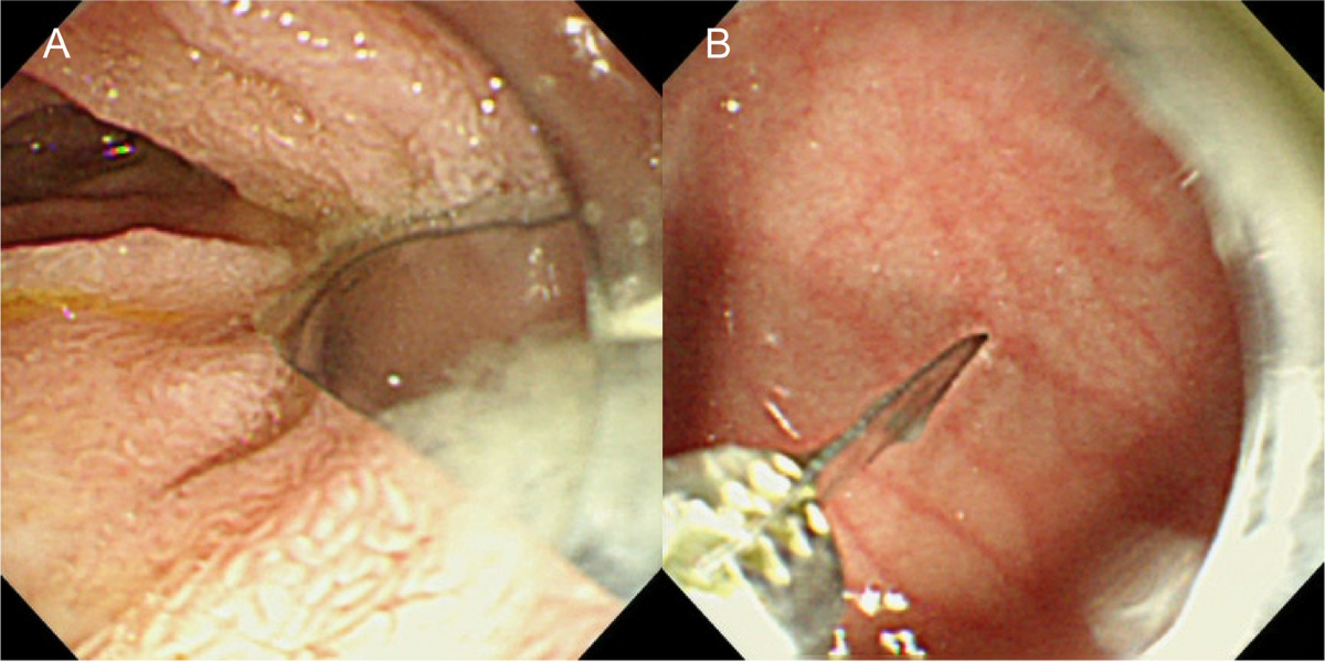accidentally swallowed tobacco Extraction of a metallic susceptor after accidental ingestion of the heated  tobaccostick TEREA™: a case report | BMC Pediatrics