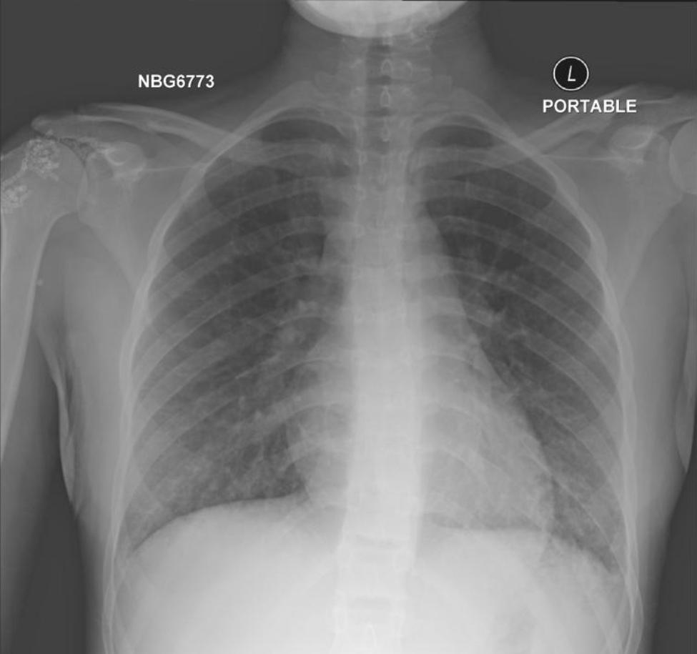 A rare case of acute eosinophilic pneumonia induced by vaping-associated  lung injury: a case report | BMC Pulmonary Medicine | Springer Nature Link