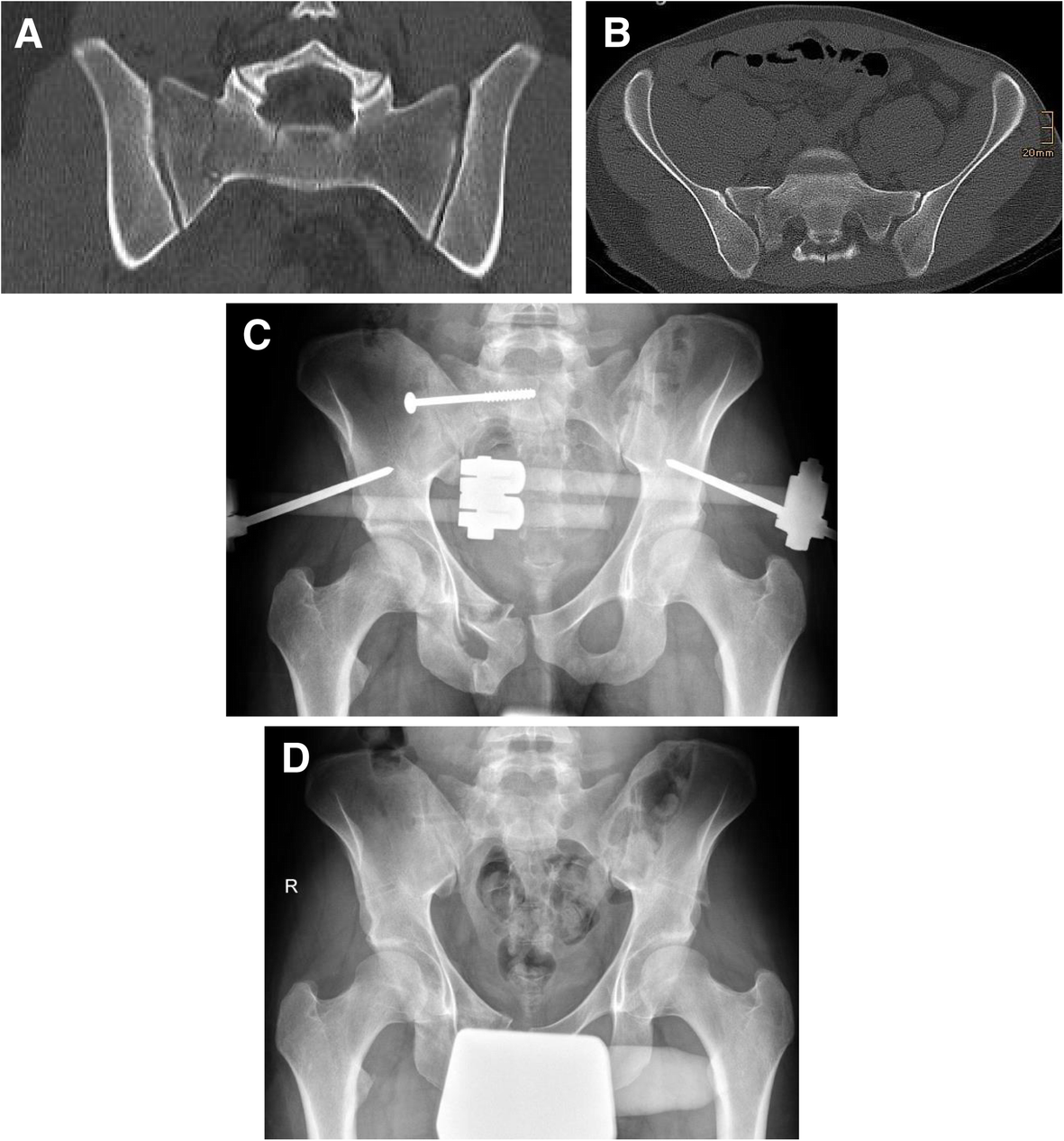 Young–Burgess classification: Inter-observer and inter-method agreement  between pelvic radiograph and computed tomography in e