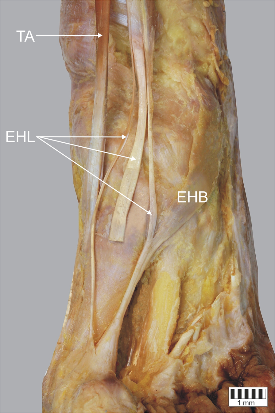 A cadaveric study of the morphology of the extensor hallucis longus - a  proposal for a new classification | BMC Musculoskeletal Disorders, image size:896x1343