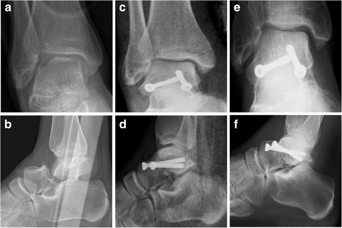 Long-term radiographic and clinical-functional outcomes of isolated,  displaced, closed talar neck and body fractures treated by ORIF: the timing  of surgical management | BMC Musculoskeletal Disorders