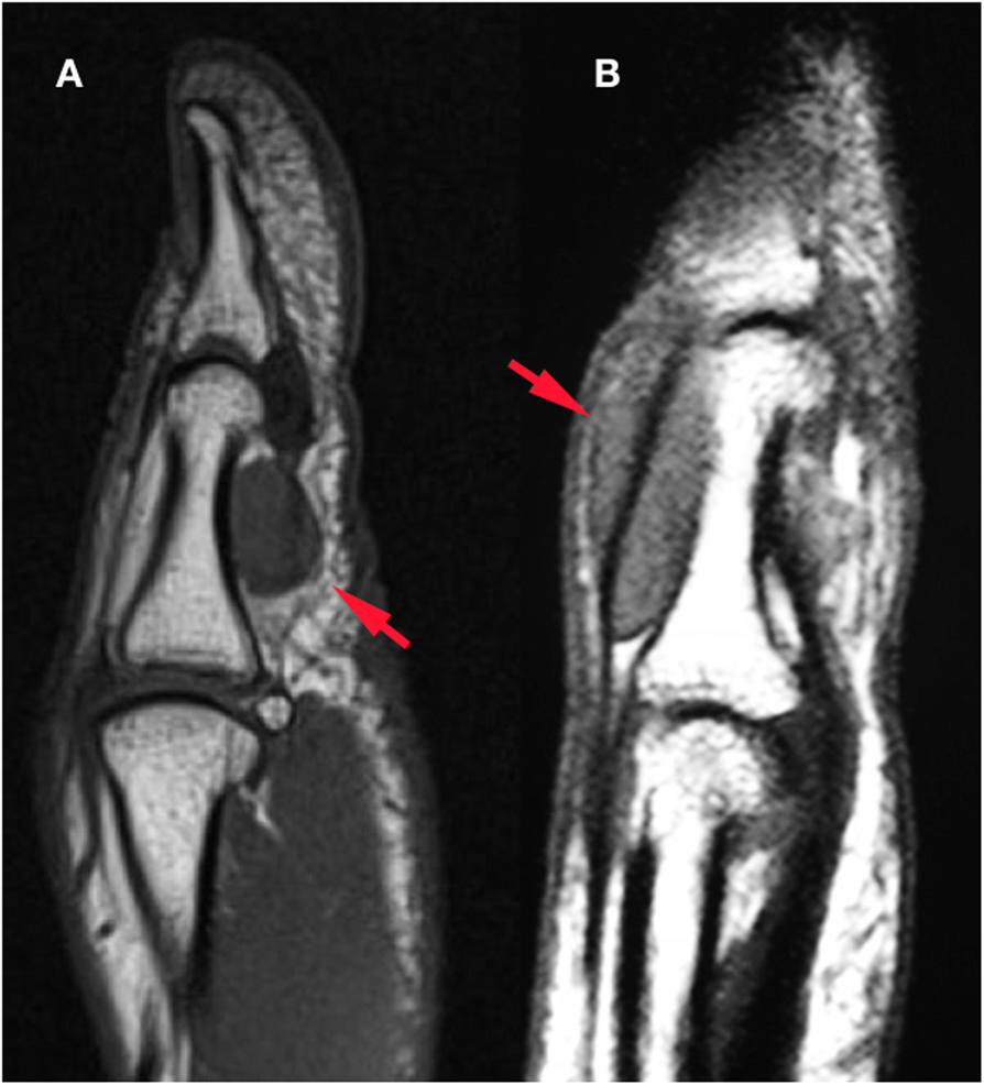 Giant cell tumor of tendon sheath in the hand: analysis of risk factors for  recurrence in 50 cases | BMC Musculoskeletal Disorders, image size:894x986