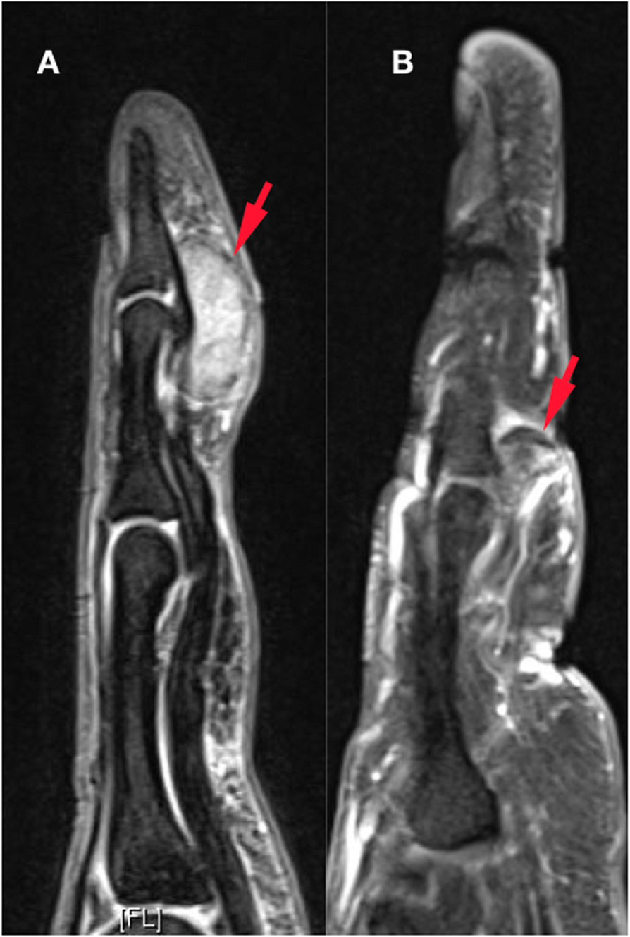 Giant Cell Tumour of Bone: A Comprehensive Review of Pathogenesis,  Diagnosis, and Treatment, image size:894x1329