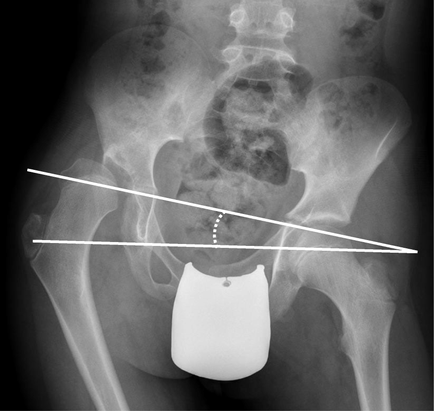 Association between pelvic obliquity and scoliosis, hip displacement and asymmetric hip abduction in children with cerebral palsyما هو انزياح أو خلع الورك عند الأطفال المصابين بالشلل الدماغي؟