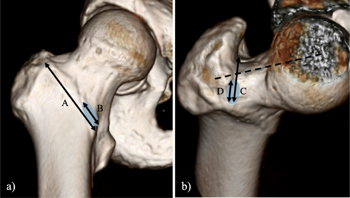 Iliofemoral Ligament - Structure, Function, Injury, image size:1200x679