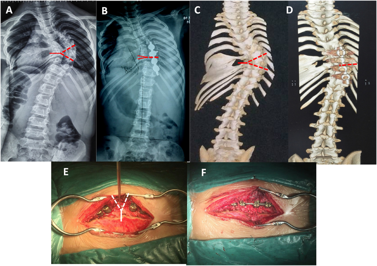 Two-staged posterior osteotomy surgery in complex and rigid congenital  scoliosis in younger than 10 years old children | BMC Musculoskeletal  Disorders | Full Text