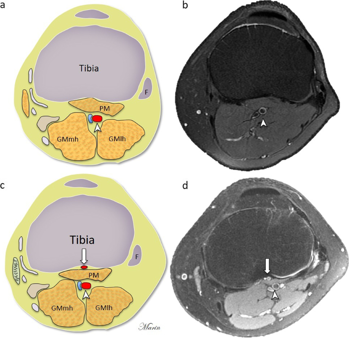 Prevalence and characteristics of the aberrant anterior tibial artery: a  single-center magnetic resonance imaging study and scoping review | BMC  Musculoskeletal Disorders, image size:1200x1161