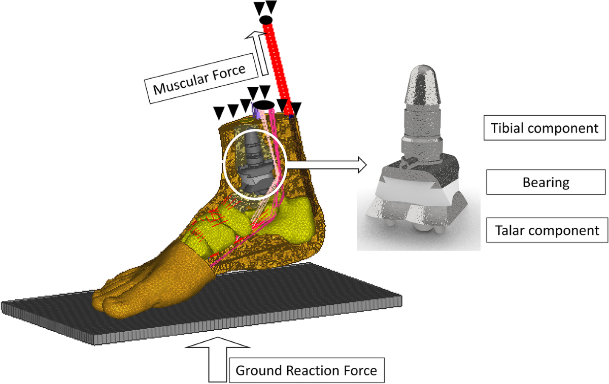 Finite element stress analysis of the bearing component and bone resected  surfaces for total ankle replacement with different implant material  combinations | BMC Musculoskeletal Disorders, image size:1200x757