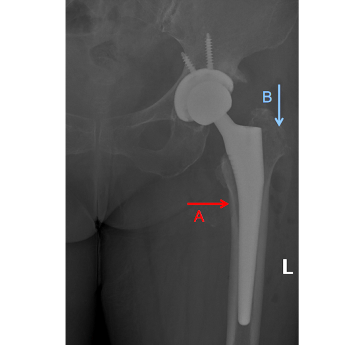The compared study about femoral stem malalignment with or without the  special curved rasp during DAA total hip arthroplasty, BMC Musculoskeletal  Disorders