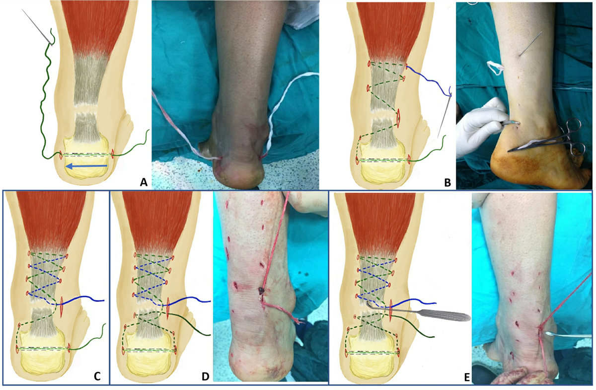 bpc 157 achilles tendon repair Early satisfactory results of percutaneous in neglected rupture | BMC Musculoskeletal Disorders Pentadecapeptide ghk cu peptide typical Color:Indigo Purple