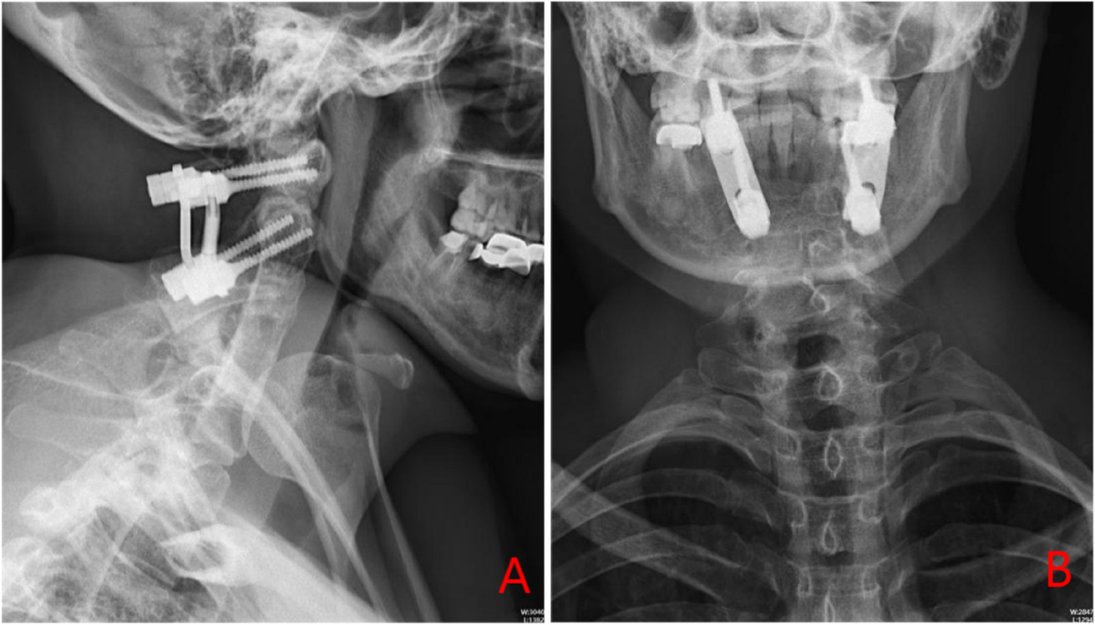 Prenatal diagnosis of Sprengel's deformity in a patient with Klippel-Feil  Syndrome - Clinical Imaging, image size:1200x685