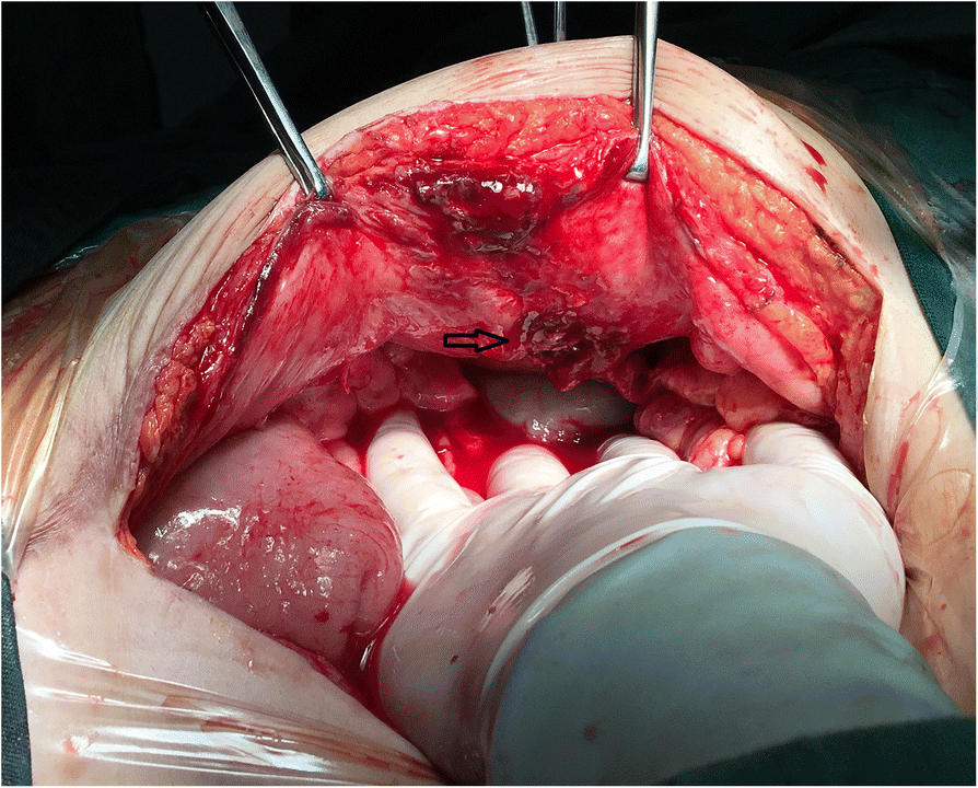 Spigelian hernia in the right upper abdominal wall: a case report ...
