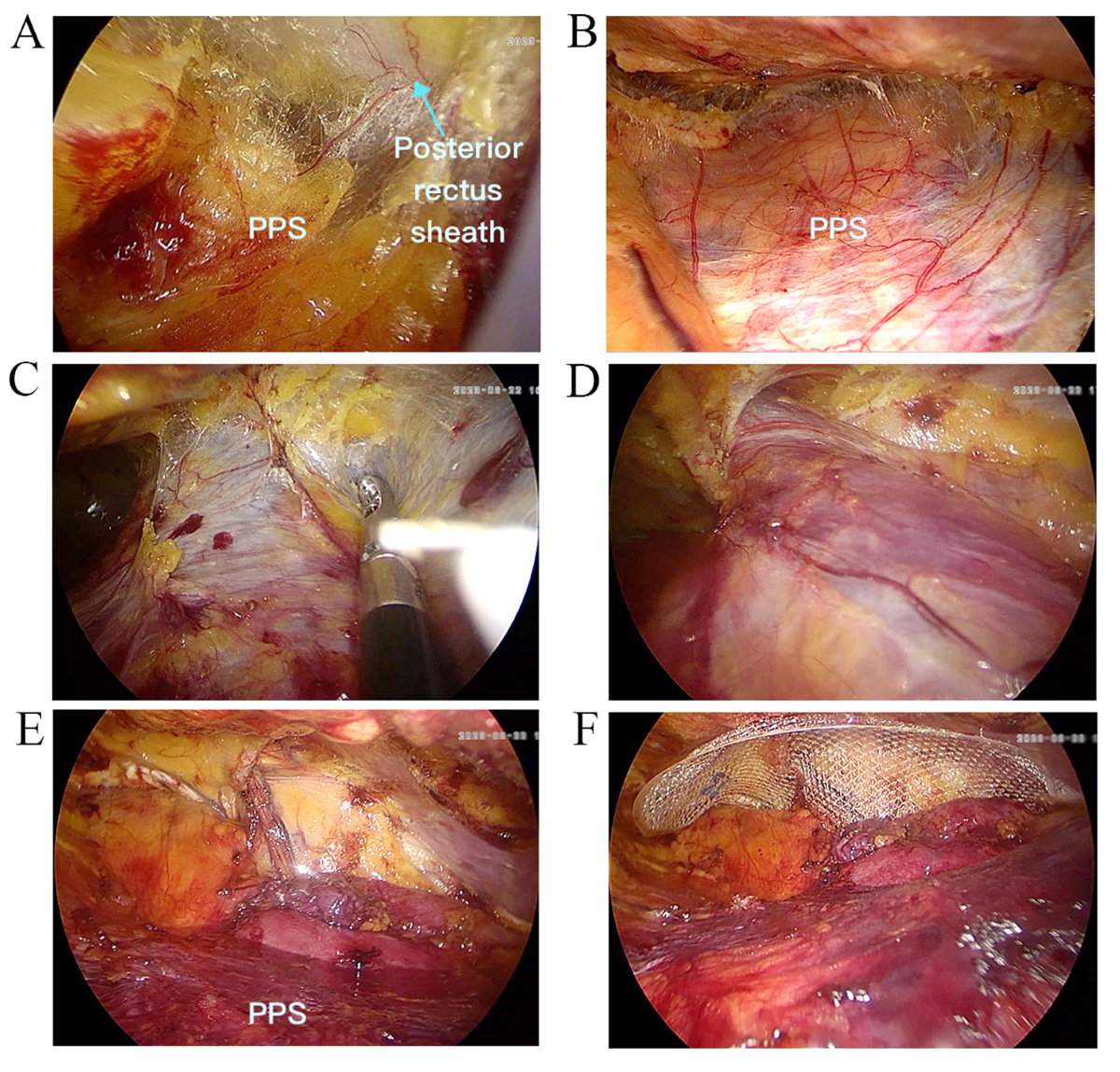 TPP (totally preperitoneal) making single incision laparoscopic inguinal  hernia repair more feasible: a comparison with single incision laparoscopic  totally extraperitoneal hernioplasty (SIL-TEP) | BMC Surgery | Springer  Nature Link