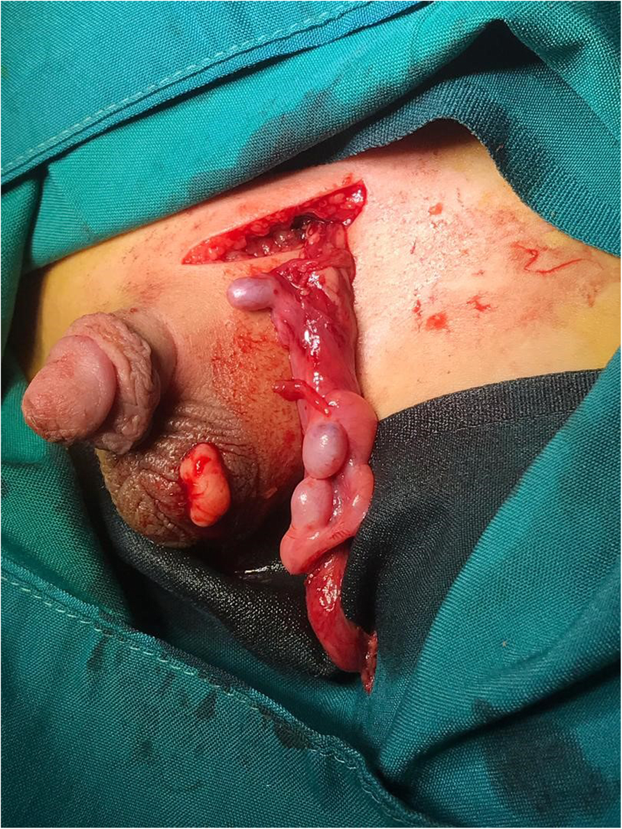  Genital modification Postoperative Course of Reconstructive Procedures in FGM Type III-Proposal  for a Modified Classification of Type III Female Genital Mutilation