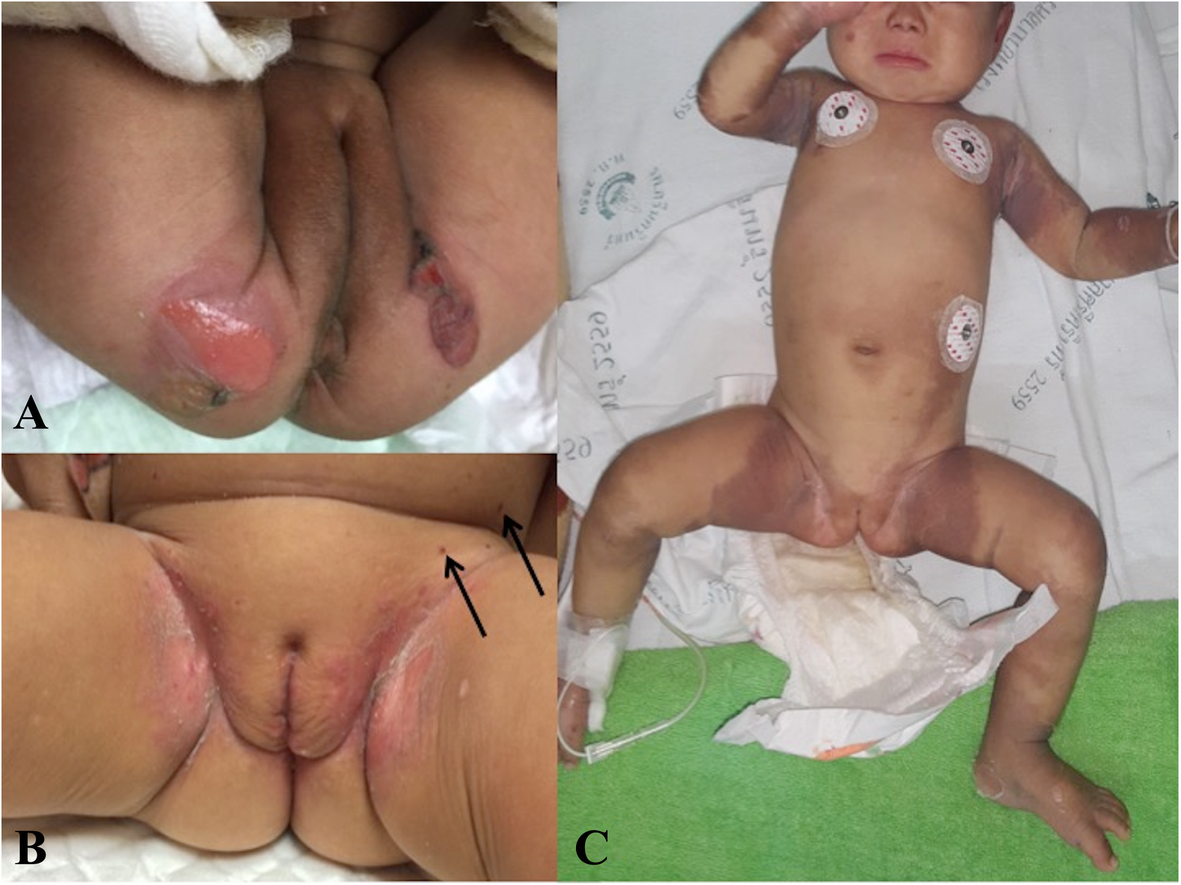diaper rash naked  