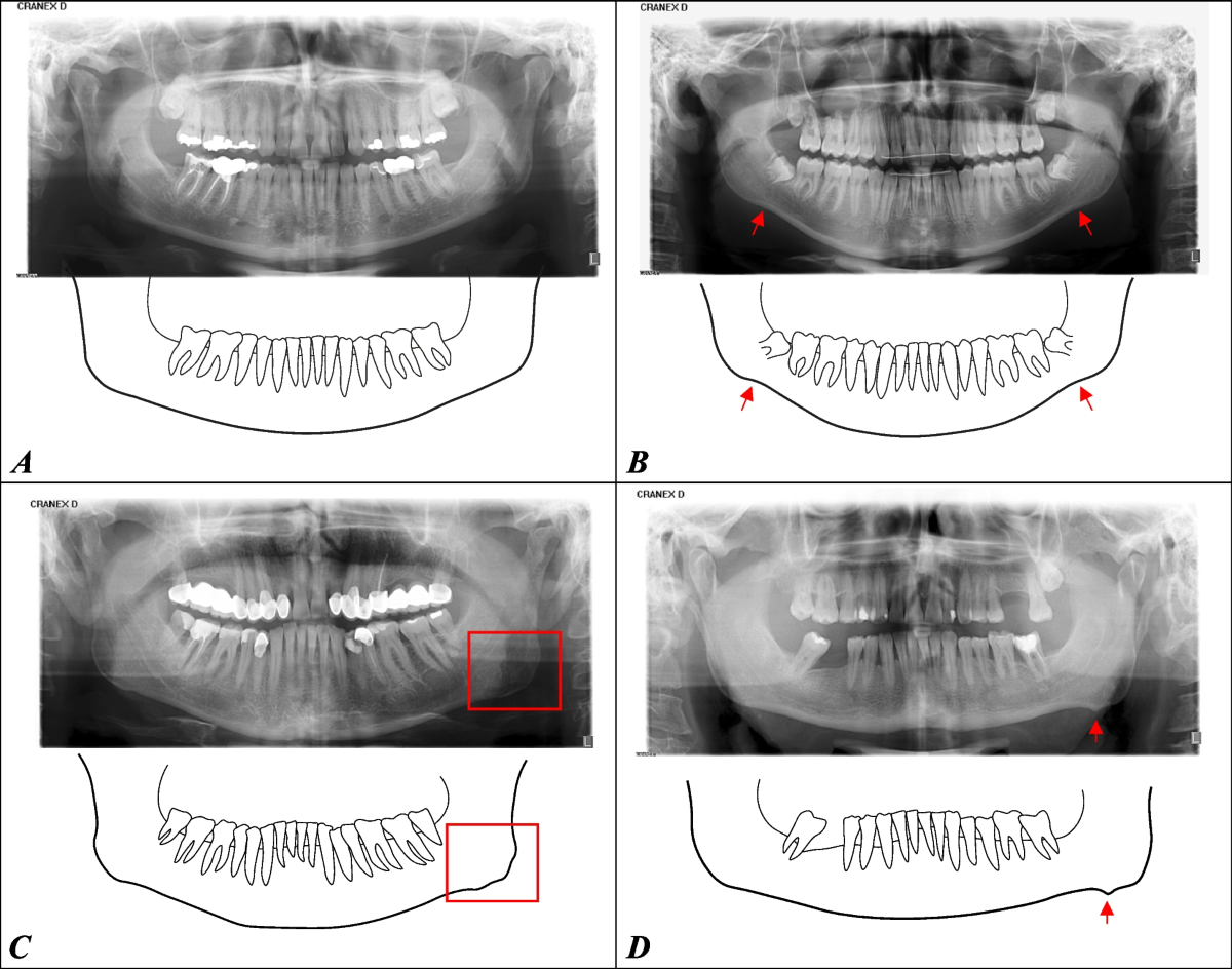 Prevalence and correlation with sex, age, and dental status of bone  apposition at the mandibular angle and radiographic alterations of the  temporomandibular joints: a retrospective observational study in an adult  Swiss population |