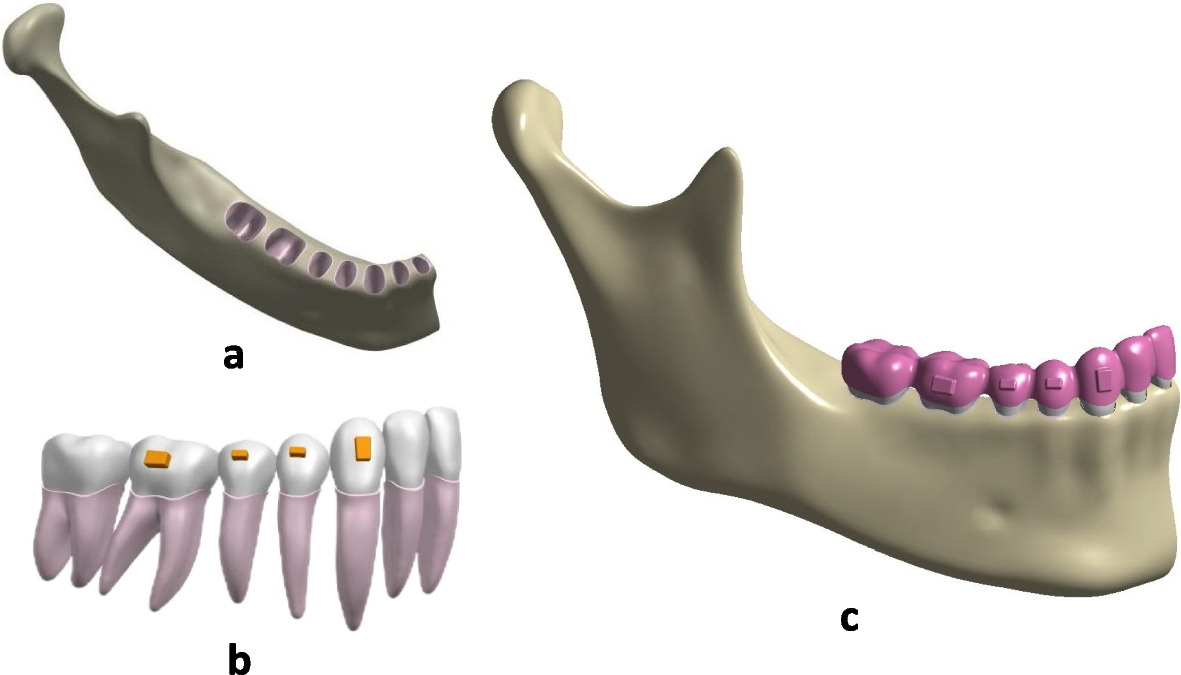 Effects of different patterns of movement for correcting a deep curve of  Spee with clear aligners on the anterior teeth: a finite element analysis |  BMC Oral Health | Springer Nature Link