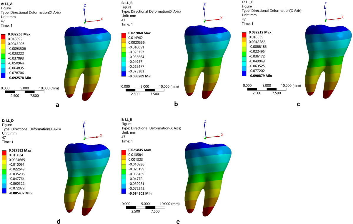 Effects of different patterns of movement for correcting a deep curve of  Spee with clear aligners on the anterior teeth: a finite element analysis |  BMC Oral Health | Springer Nature Link