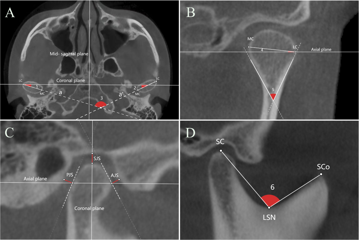 lsn imagesize Relationship between interincisal angles and TMJ morphology/position and trabecular structure: a retrospective study | BMC Oral Health | Full Text