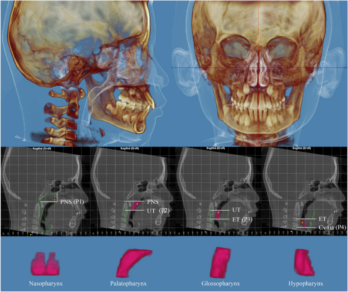 Efficacy comparison between dentofacial orthopedic treatment and  adenotonsillectomy on children with obstructive sleep apnea and skeletal  class II malocclusion: a retrospective study | BMC Oral Health | Springer  Nature Link