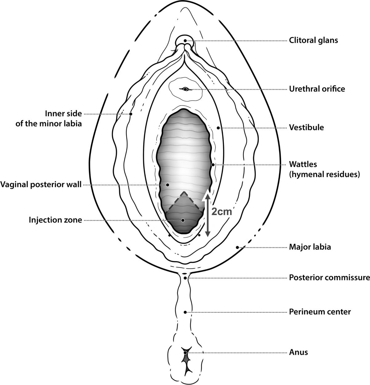 hymenal Hymen repair, also known as hymenoplasty, is a surgical procedure to  reconstruct the hymen, a thin membrane located at the vaginal opening. The  procedure is often performed for cultural, personal, or psychological