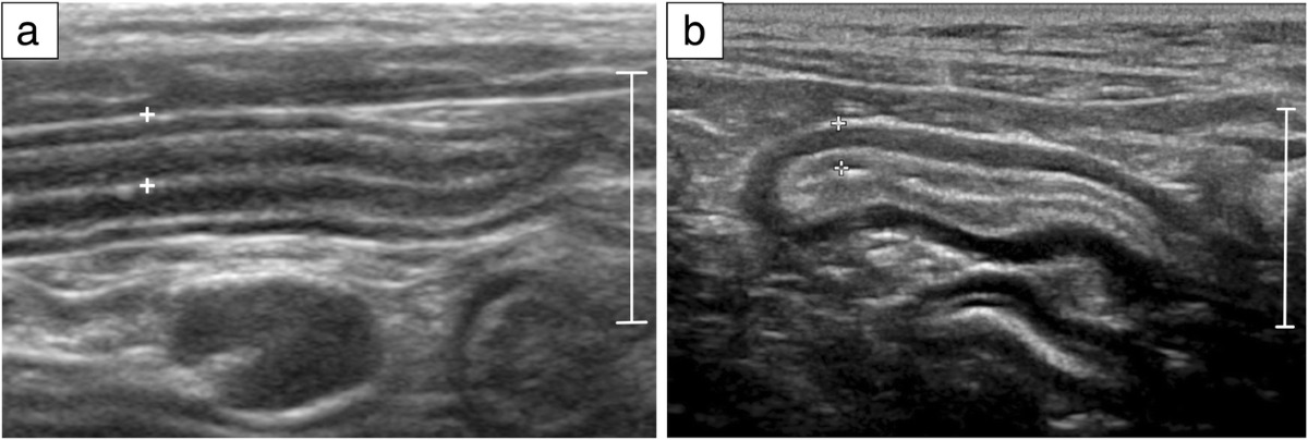 Feline low-grade alimentary lymphoma: an emerging entity and a potential  animal model for human disease | BMC Veterinary Research | Springer Nature  Link