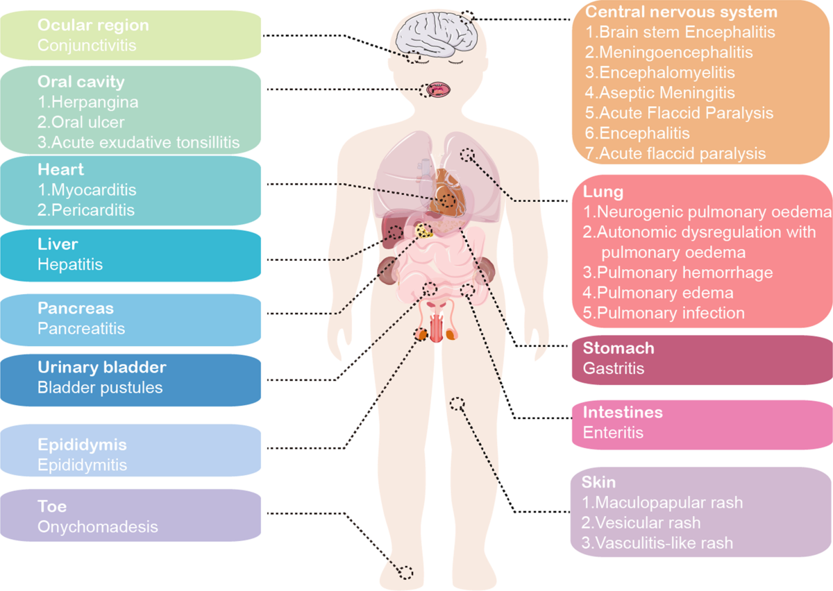 Current status of hand-foot-and-mouth disease | Journal of 