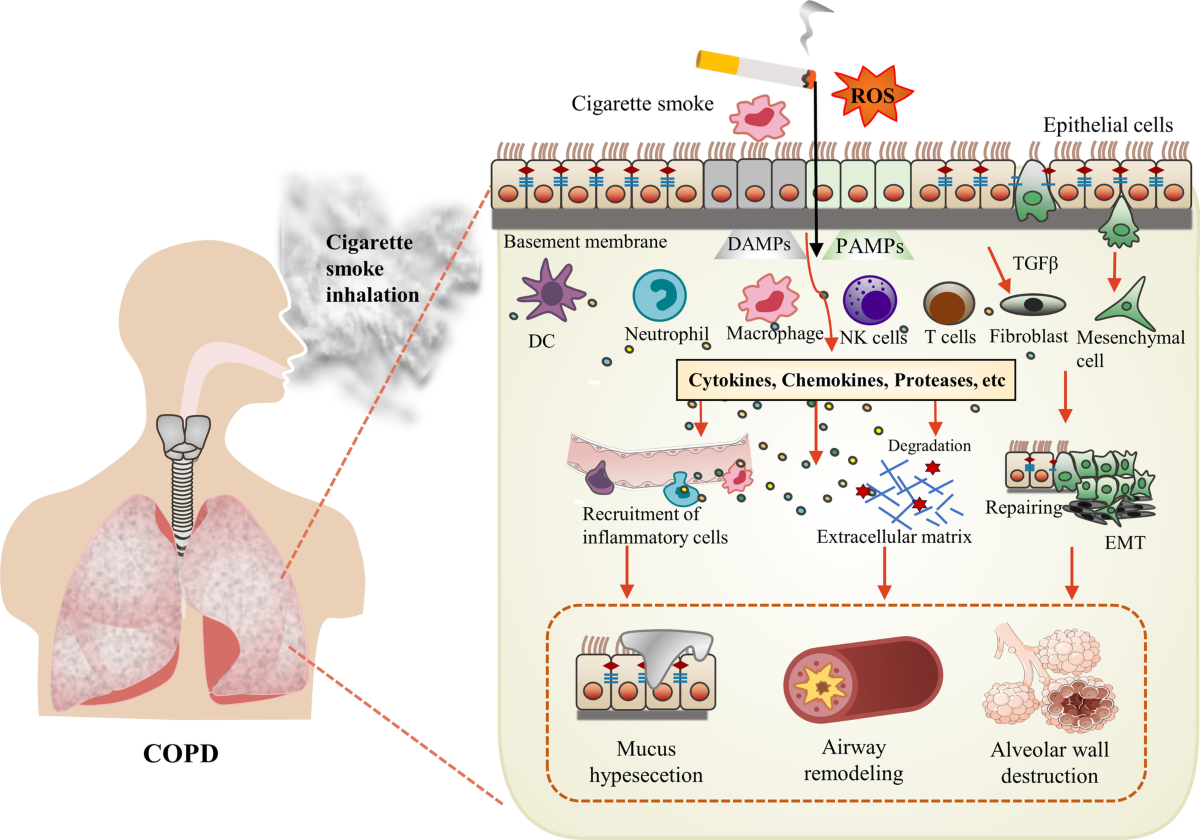 what chemical in cigarettes causes emphysema The effects of epithelial–mesenchymal transitions in COPD induced by cigarette  smoke: an update | Respiratory Research