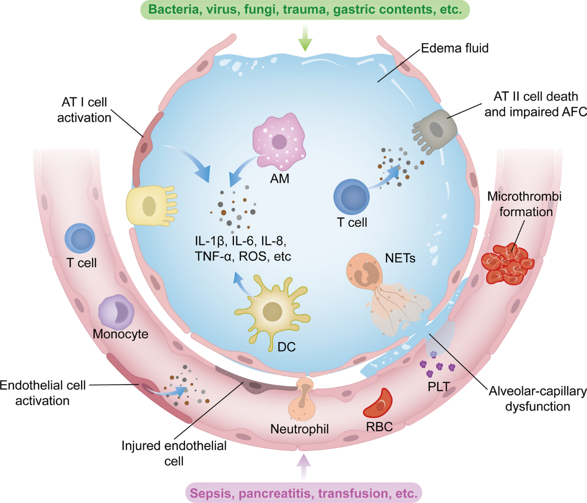 glutathione ards Signaling pathways and potential therapeutic targets in acute respiratory  distress syndrome (ARDS) | Respiratory Research