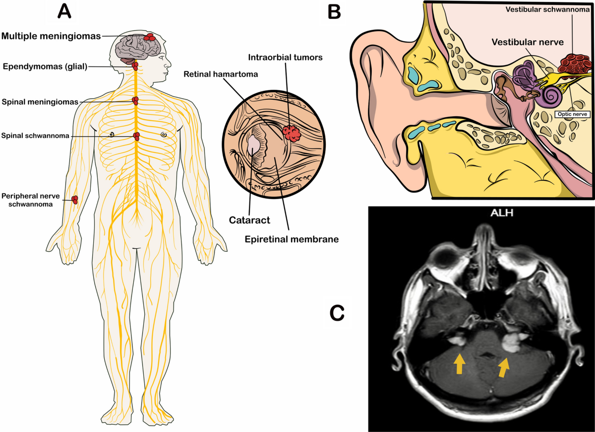 The genetic landscape and possible therapeutics of 