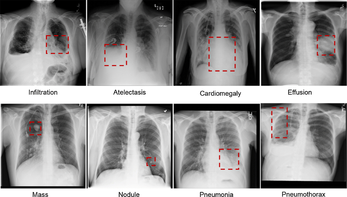 Pneumonia Chest X Ray Diagnosis & Findings