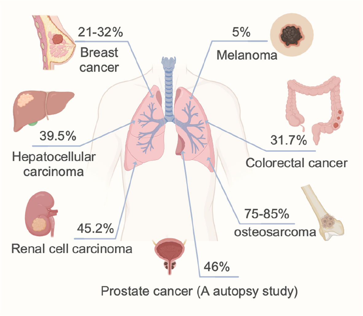 Lung-specific metastasis: the coevolution of tumor cells and lung  microenvironment | Molecular Cancer | Springer Nature Link