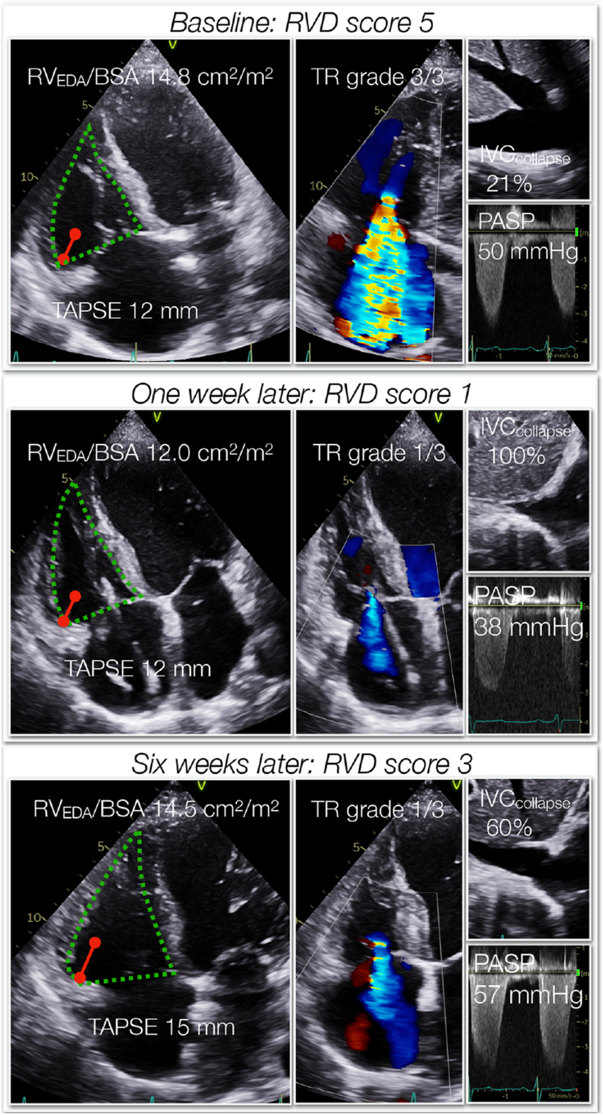 A novel echocardiographic right ventricular dysfunction score can identify  hemodynamic severity profiles in left ventricular dysfunction |  Cardiovascular Ultrasound | Springer Nature Link