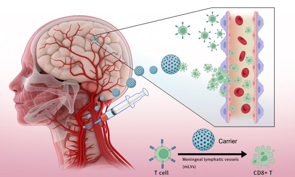 tirzepatide and swollen lymph nodes New trends in brain tumor immunity with the opportunities of lymph nodes  targeted drug delivery | Journal of Nanobiotechnology