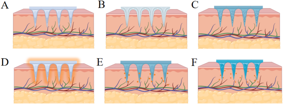 Advances in microneedle-based drug delivery system for metabolic diseases: structural considerations, design strategies, and future perspectives | Journal of Nanobiotechnology | Springer Nature Link Advances in microneedle-based drug delivery system for metabolic diseases: structural considerations, design strategies, and future perspectives | Journal of Nanobiotechnology | Springer Nature Link