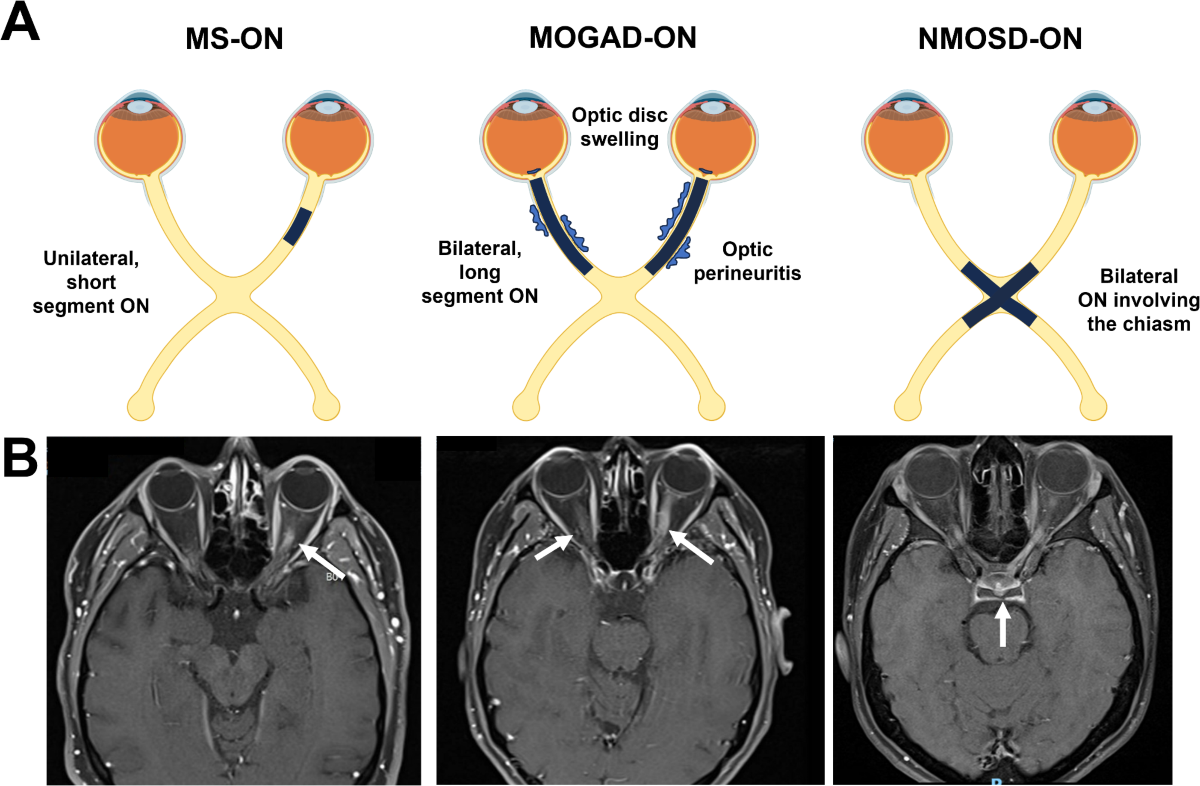 MOG35 − 55-induced EAE model of optic nerve inflammation compared to MS,  MOGAD and NMOSD related subtypes of human optic neuritis | Journal of  Neuroinflammation | Springer Nature Link