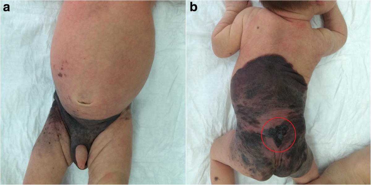 giant melanotic hairy nevus Two-Stage Approach to Managing a Congenital Melanocytic of the Scalp in an Infant Asploro Open Access Publications Treatment of a Congenital Melocytic