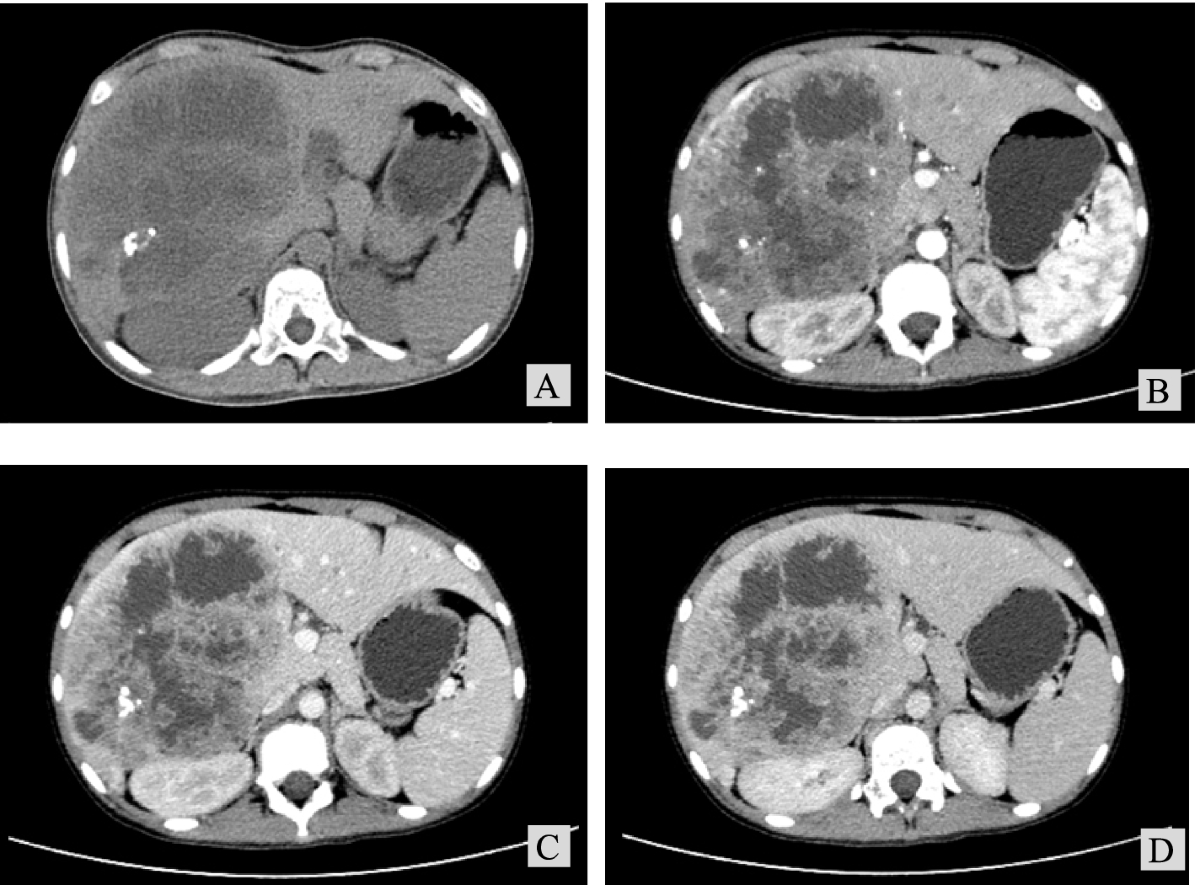 melanotic sarcoma liver Biphasic synovial sarcomas of the liver: a case report and literature review | Diagnostic Pathology Liver Atlas: Case 159: Metastasis