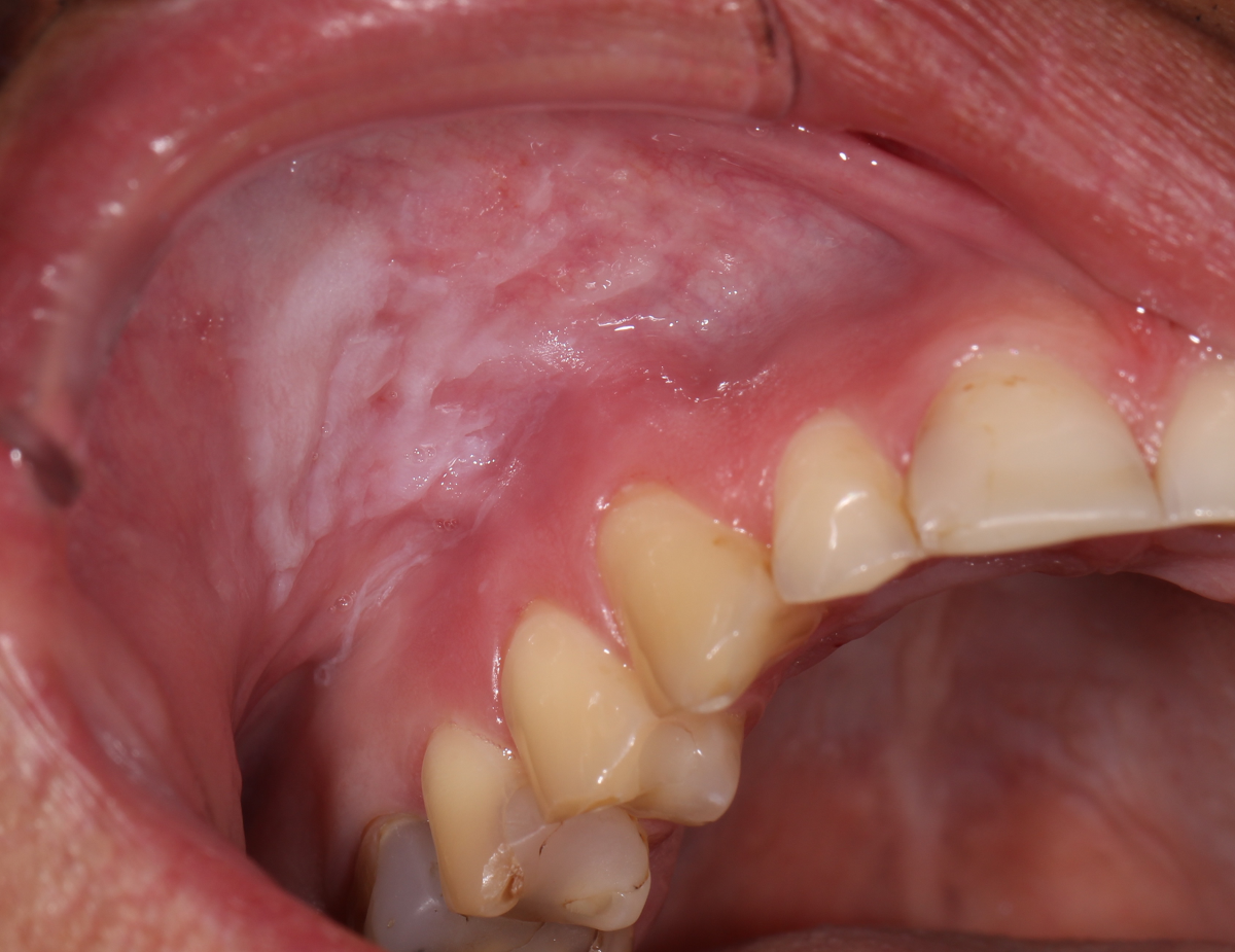 does chewing tobacco cause canker sores Oral mucosal changes caused by nicotine pouches: case series | Diagnostic  Pathology
