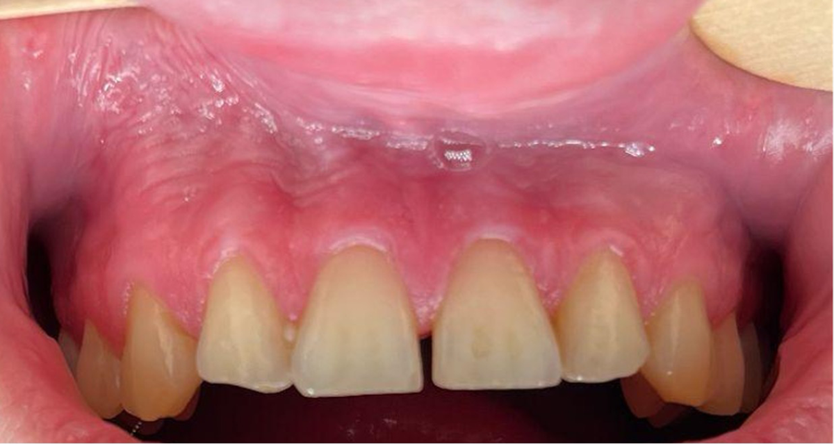 Oral mucosal changes caused by nicotine pouches: case series | Diagnostic  Pathology