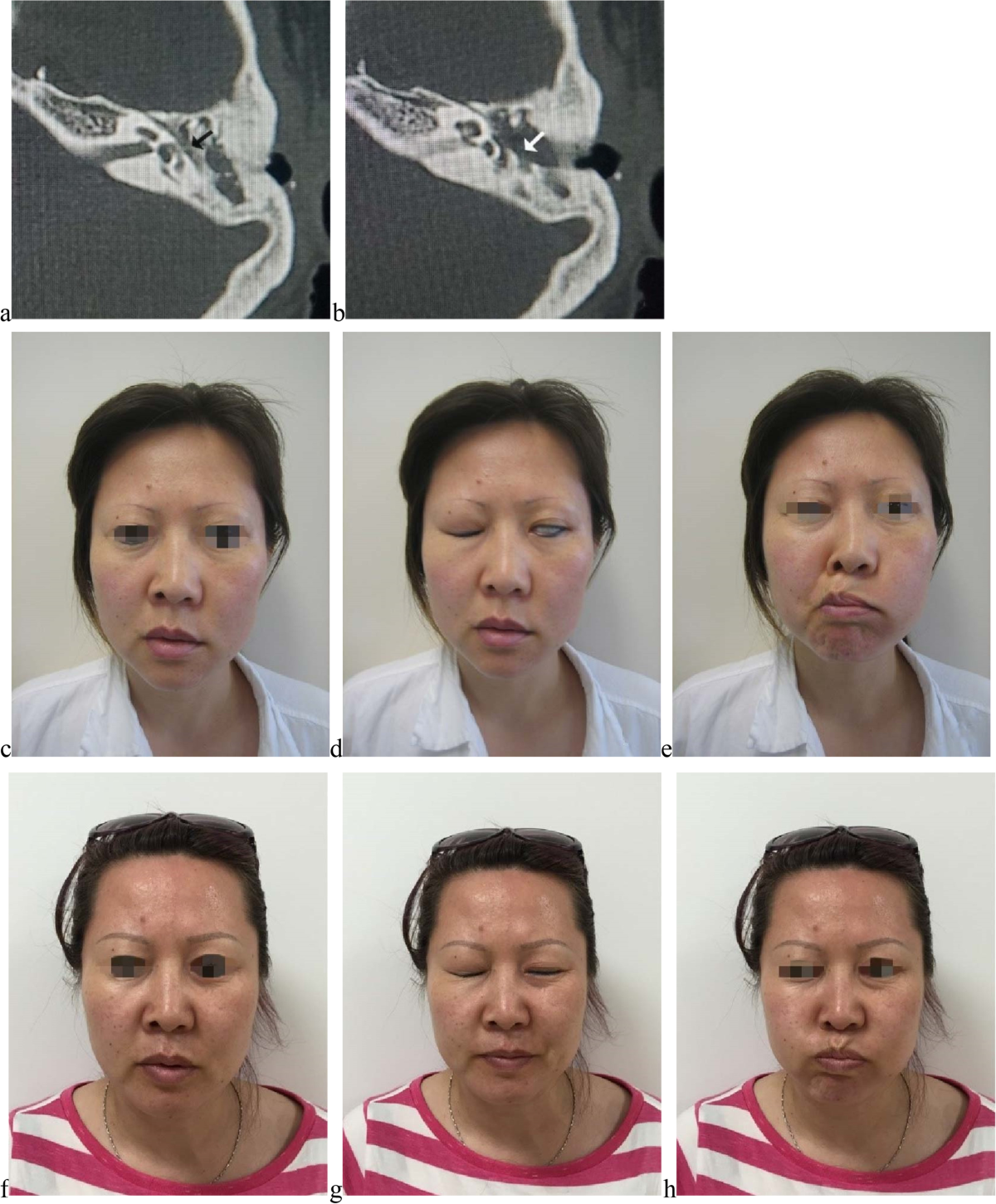 Surgical management and the prognosis of iatrogenic facial nerve injury in  middle ear surgery: a 20-year experience | Head \u0026 Face Medicine, image size:1200x1451